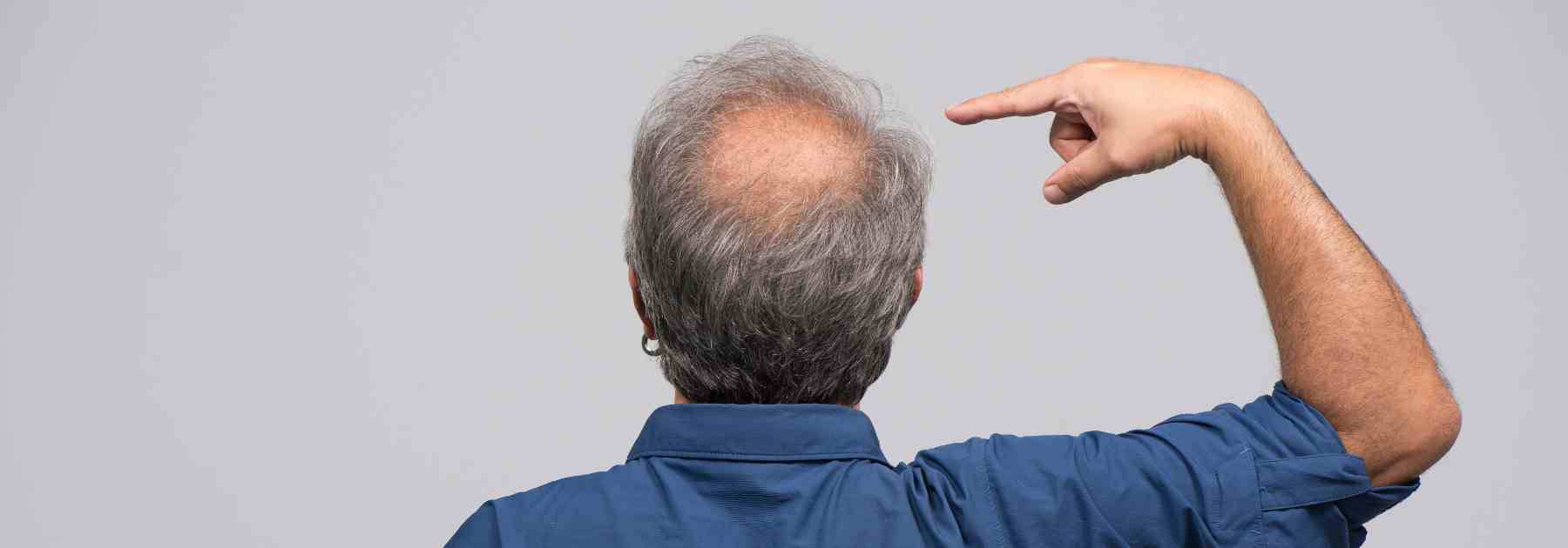 Combat male pattern baldness with finasteride for hair loss